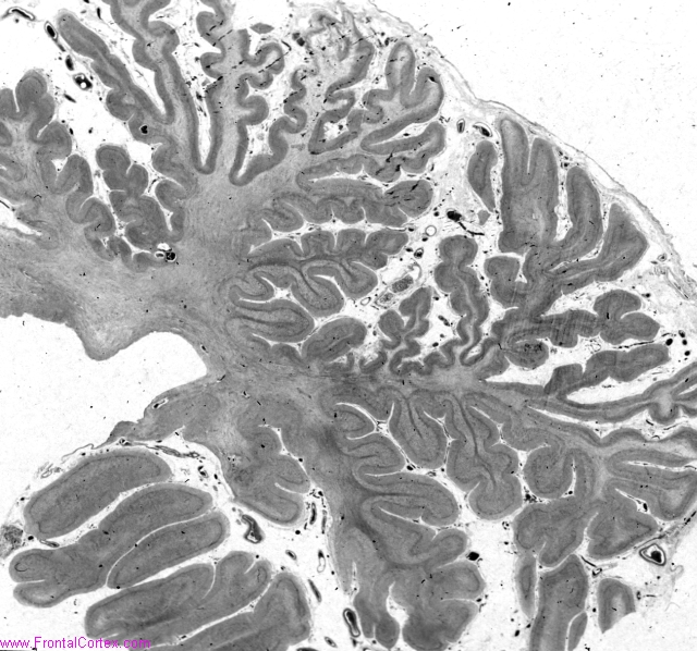 Multiple cavernous  malformations, familial, cerebellum (whole mount)
